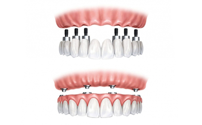 All On 6 dental implants
