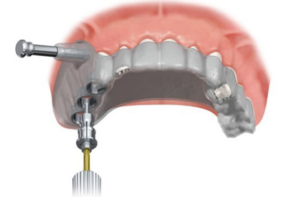 Computer guided implant surgery