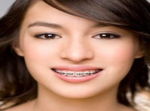 Correction of Crooked/Misaligned teeth/Braces/Orthodontic Treatment