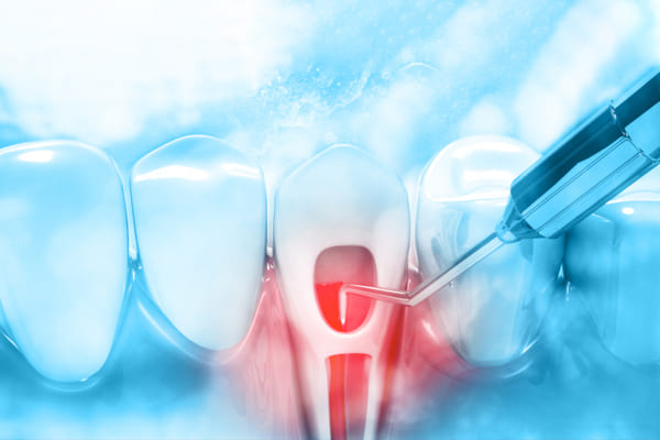 Pioneer Expertise Hydrolic Sinus Lift, Laser Gum
                            Treatment, Root Canal, LASER Dentistry, Dental Braces & Any Dental Problem