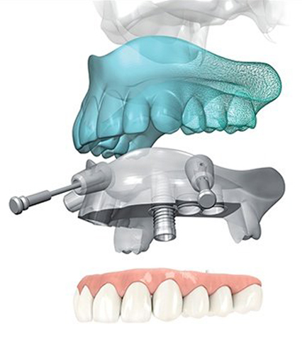 computer guided implant surgery