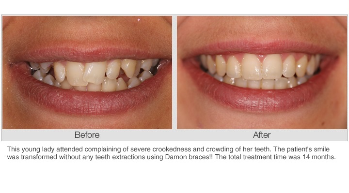 Take care of your crooked teeth