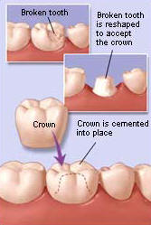Fix Broken teeth & Cavities Crown
